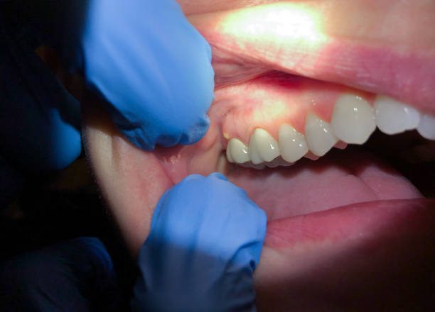 Best Broken or Cracked Tooth Emergency Dentist in Lincoln Park, NY